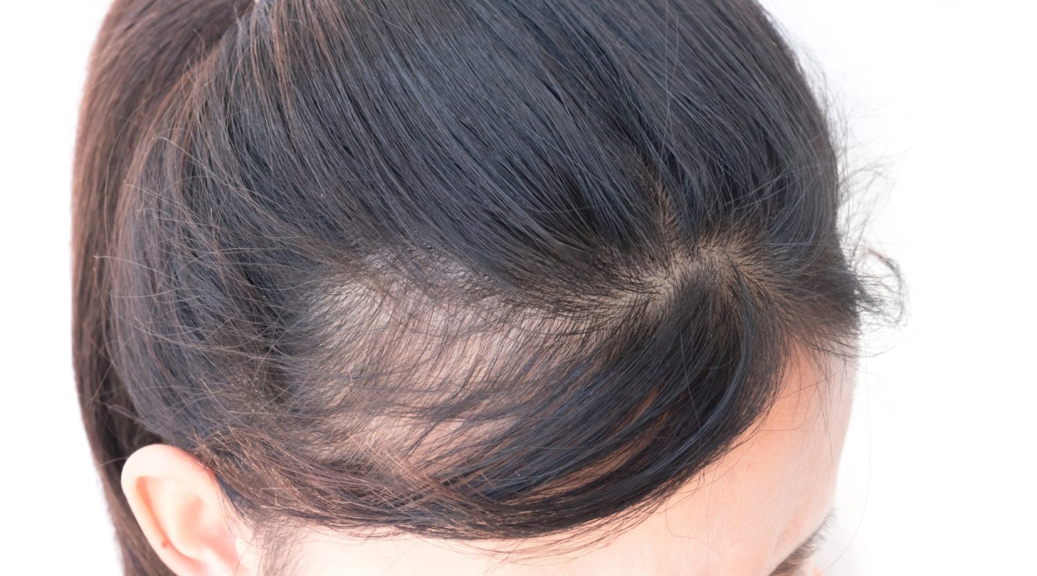 Thinning Hair And Hair Loss Could It Be Female Pattern Hair Loss